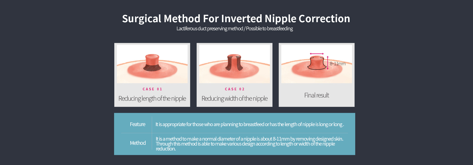 Surgical Method For Inverted Nipple Correction, step 1. Reducing length of the nipple, step 2. Reducing width of the nipple, step 3. Final result