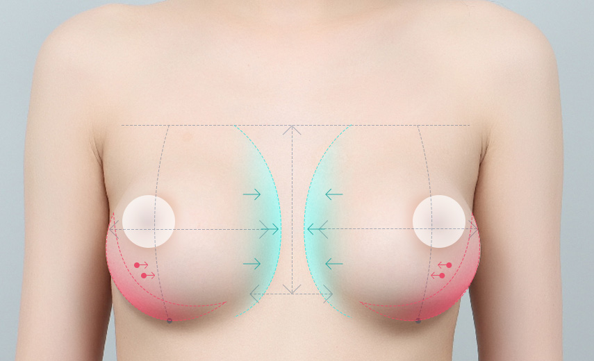 inner breasts for the space of capsule