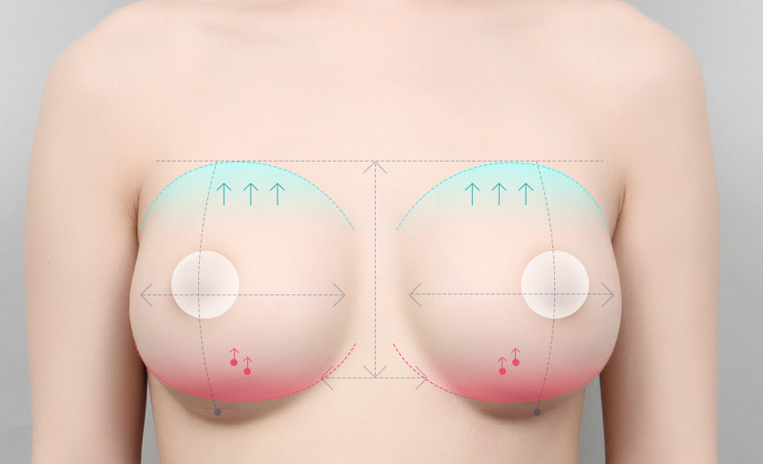 Improve the overall breast shape and texture through disinsertion of existing descended breast pocket to disinsert the upper pole breast by fixating the lower pole breast not to bottom out