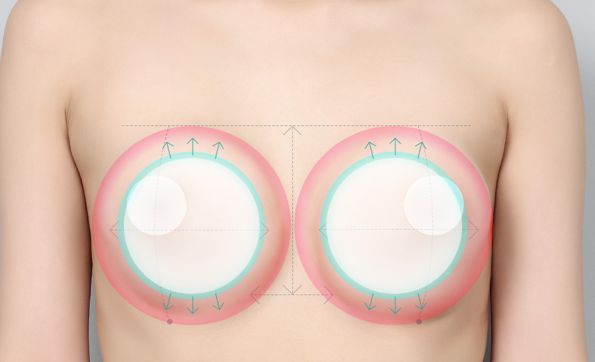 implants for breasts texture and shape