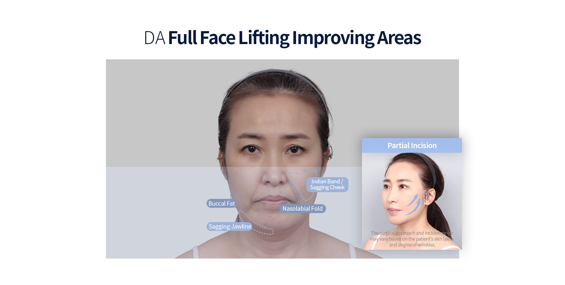 DA Full face lifting improving part