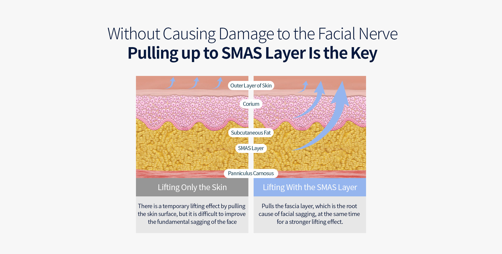 without causing damage to the facial nerve Pulling up to SMAS layer is the key