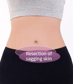  Resection of sagging skin