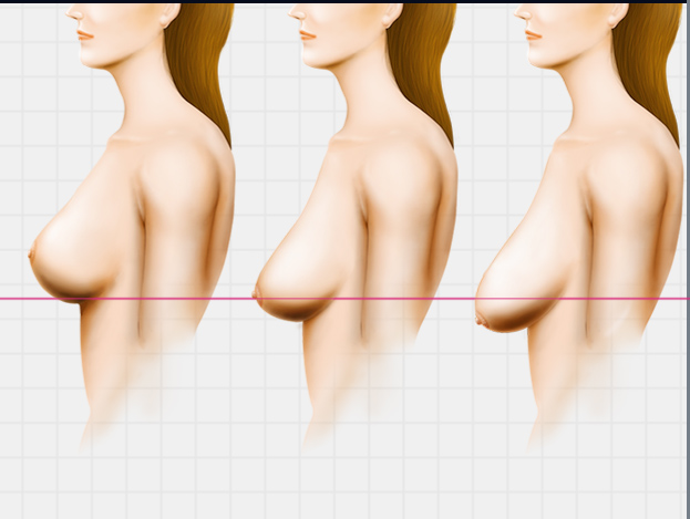 elf Diagnosis Method For Saggy Breasts
