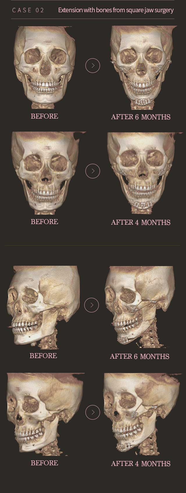 Genioplasty Chin Length Extension/Reduction Surgery