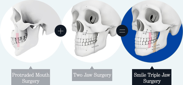 Smile Triple Jaw Surgery