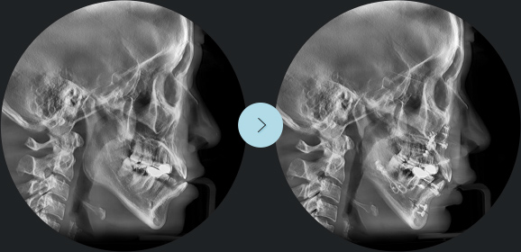  two jaw surgery is not sufficient enough