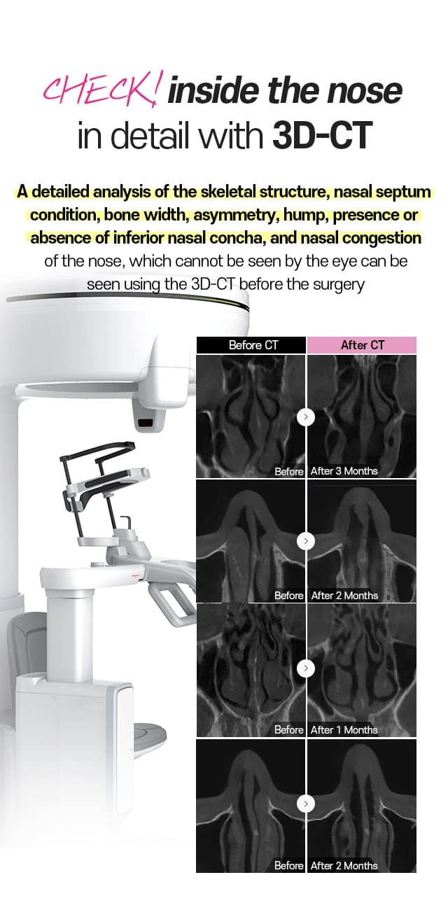 Check inside the nose in detail with 3D-CT