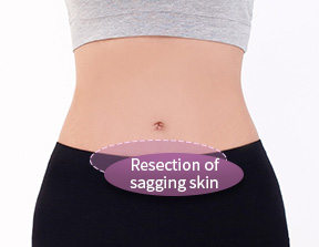  Resection of sagging skin