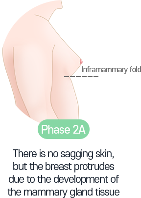 There is no sagging skin, but the breast protrudes due to the development of the mammary gland tissue