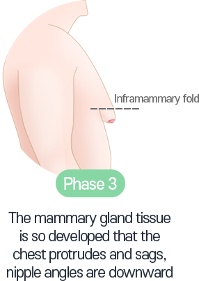 The mammary gland tissue is so developed that the chest protrudes and sags, nipple angles are downward