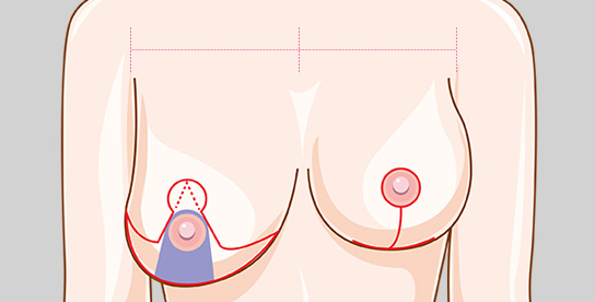 Severe-Breast Hypertrophy