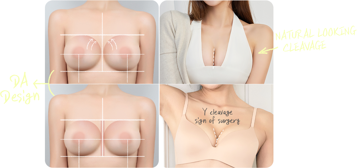 DA breast augmentation