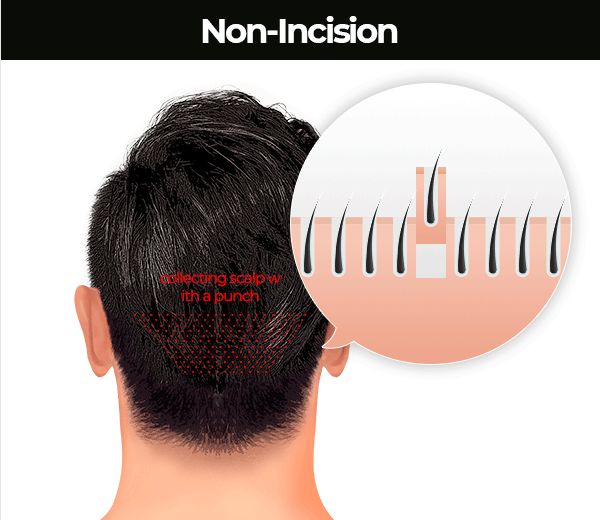 Non-incision