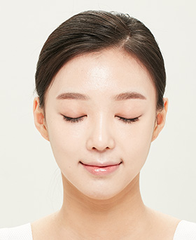 Forehead Reduction Surgery Method 04