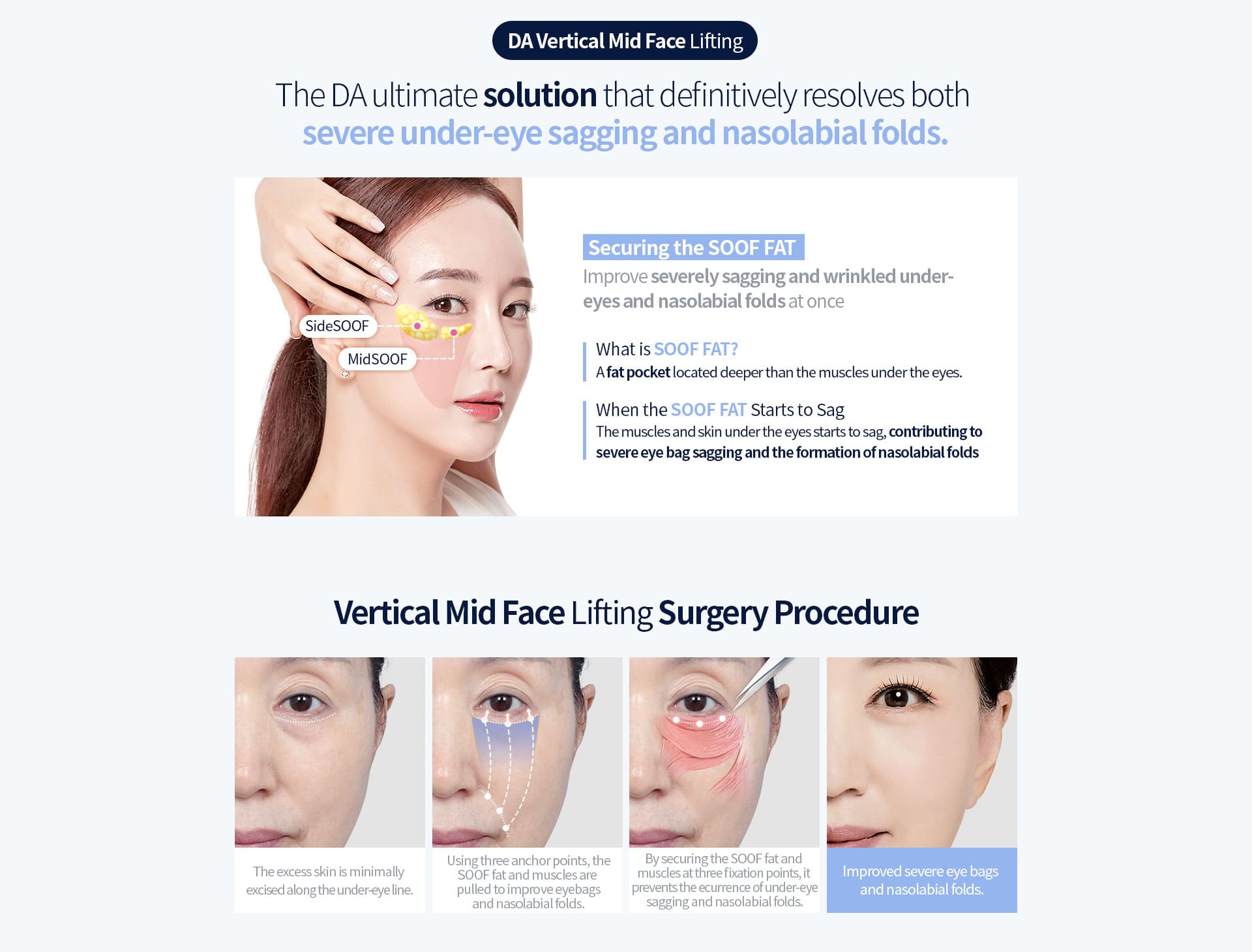 DA Vertical Mid Face Lifting