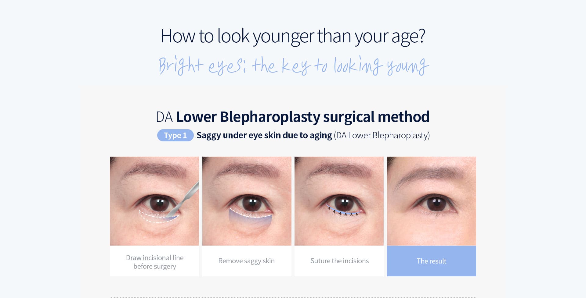 DA lower blepharoplasty