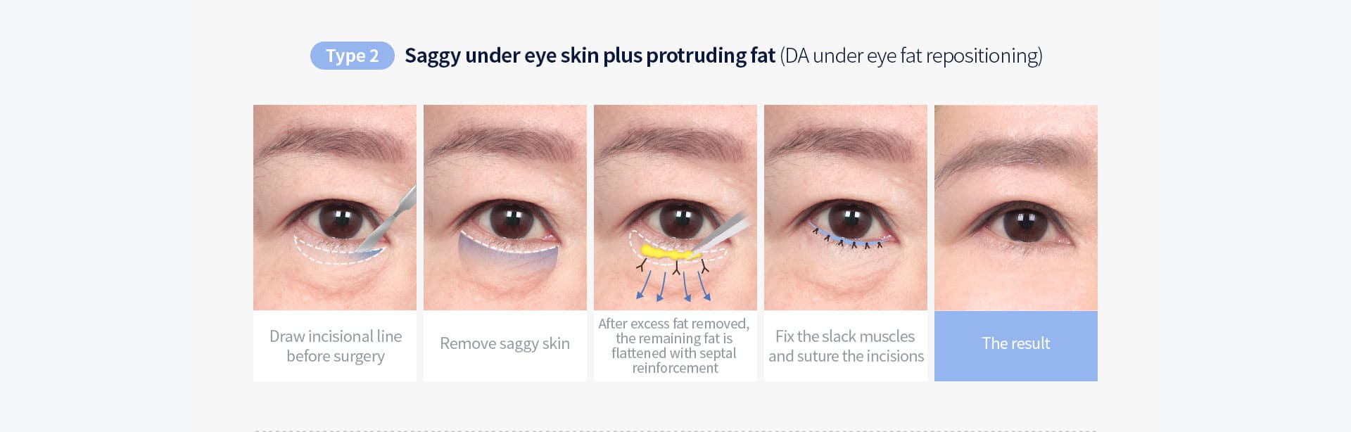 DA lower blepharoplasty