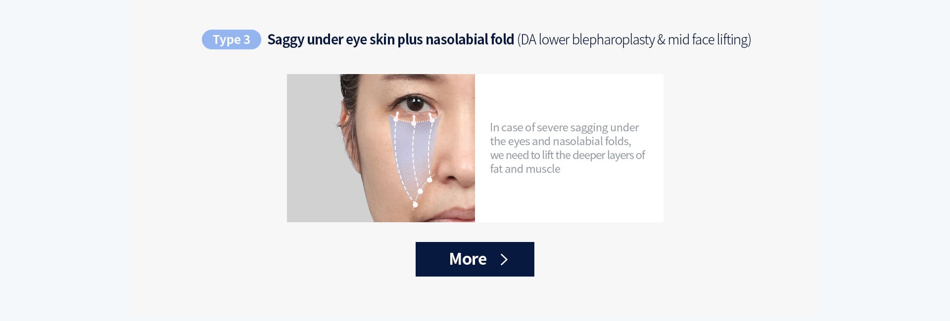 DA lower blepharoplasty