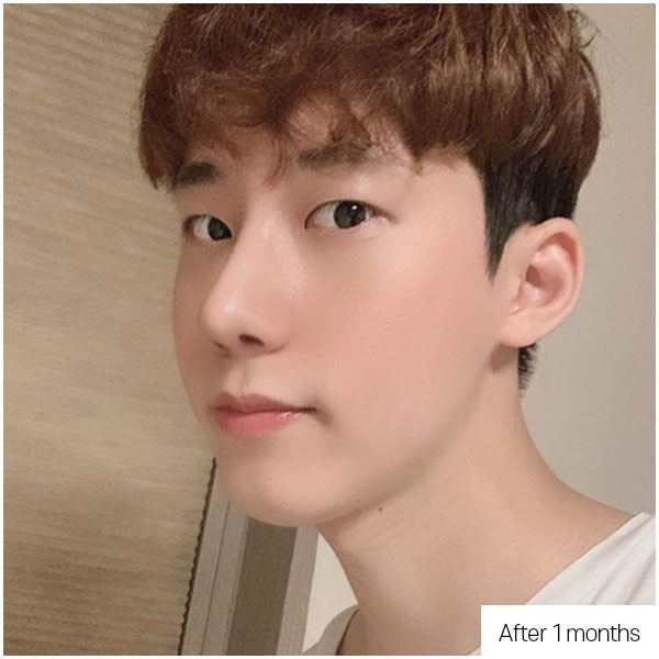 Long Nose·Arrow Nose Rhinoplasty before&after