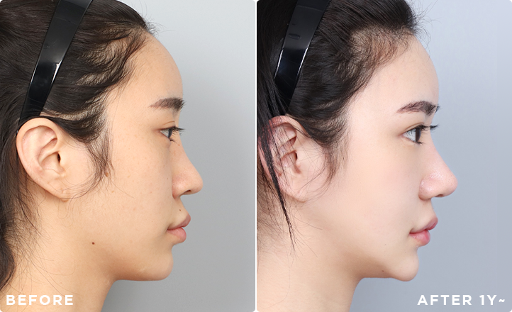 DA Revision Rhinoplasty