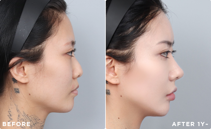 DA Revision Rhinoplasty