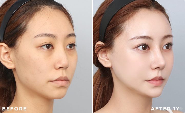 DA Revision Rhinoplasty