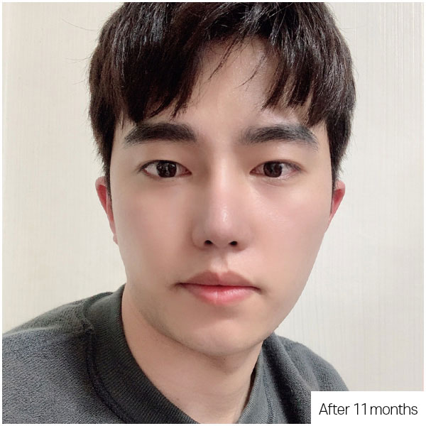 Short · Upturned nose correction before&after
