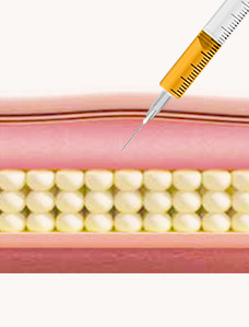Skin Injection