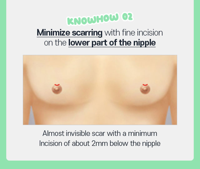 Double Gynecomastia