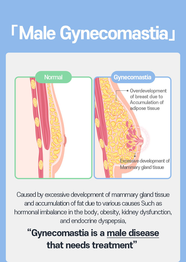 Double Gynecomastia