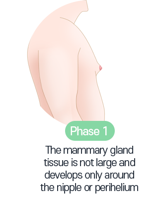 Double Gynecomastia