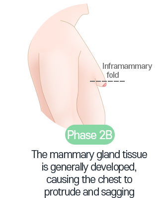 Double Gynecomastia