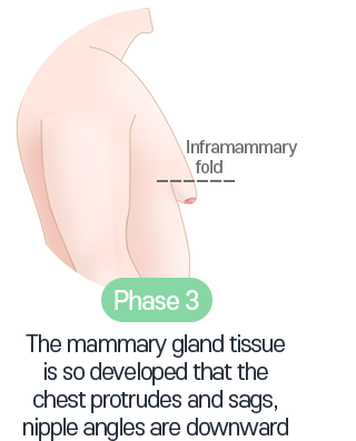 Double Gynecomastia