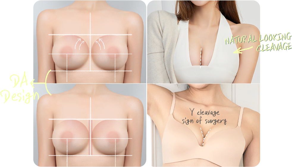 DA breast augmentation