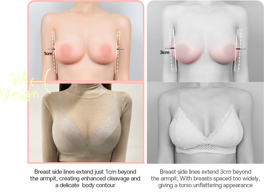 DA breast augmentation