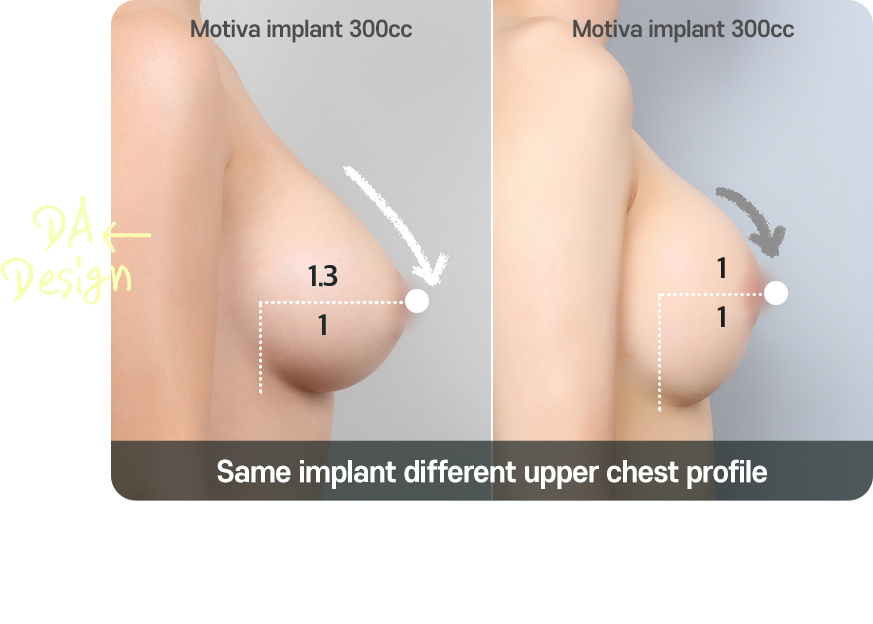 DA breast augmentation