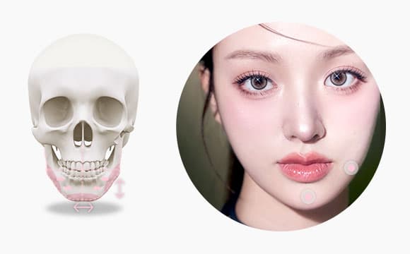 DA Genioplasty image