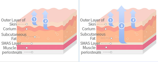 SMAS Triple-Layer Lifting images