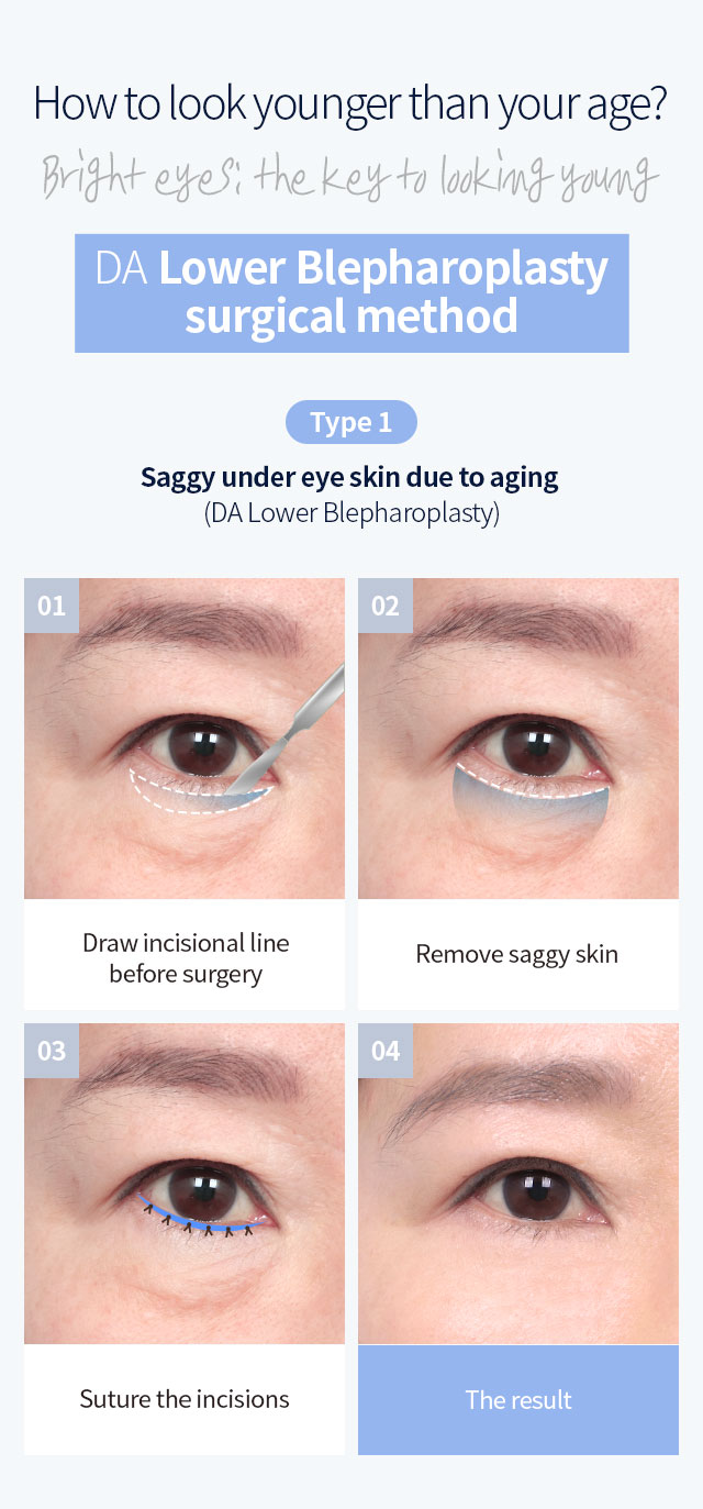 DA lower blepharoplasty