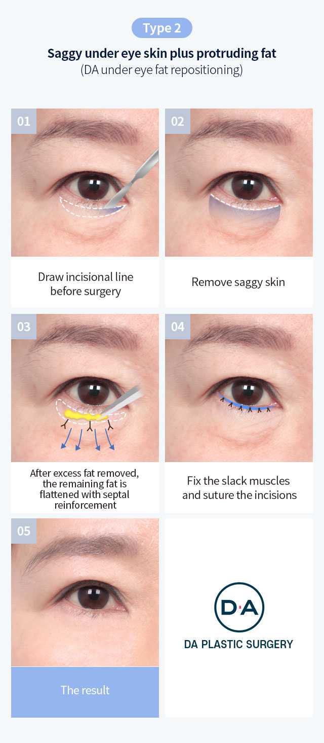 DA lower blepharoplasty