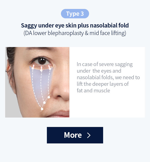 DA lower blepharoplasty