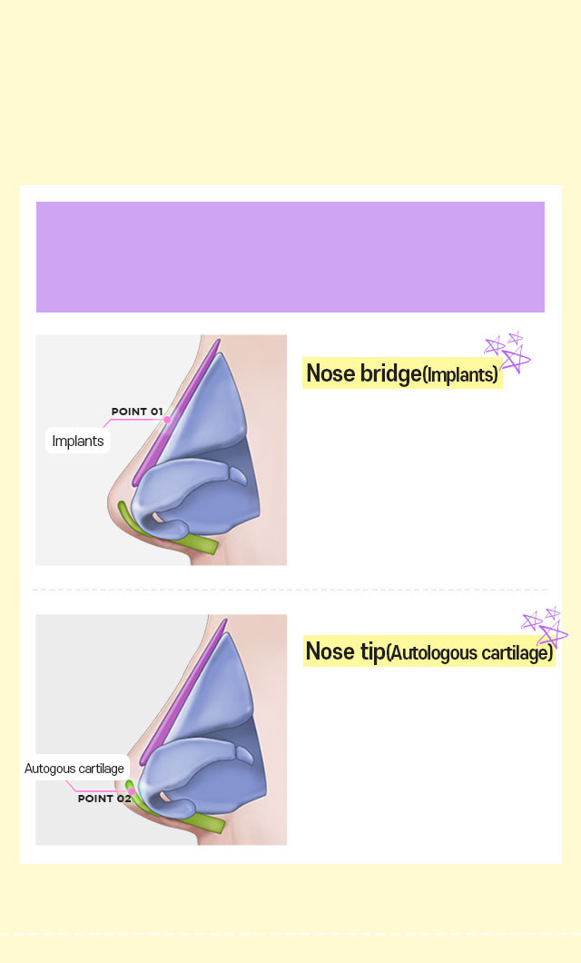DA Flat nose surgery method