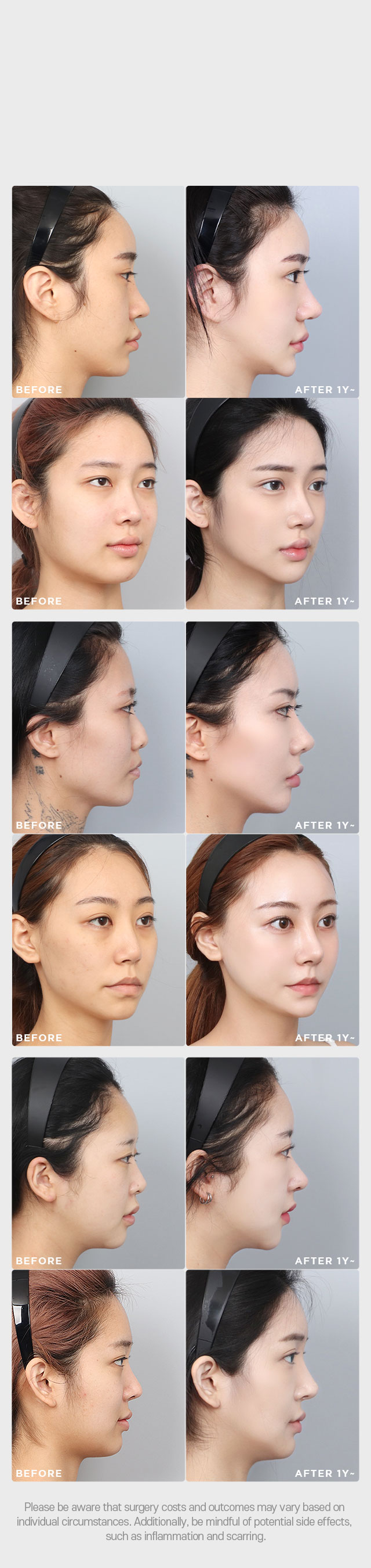 DA Revision Rhinoplasty