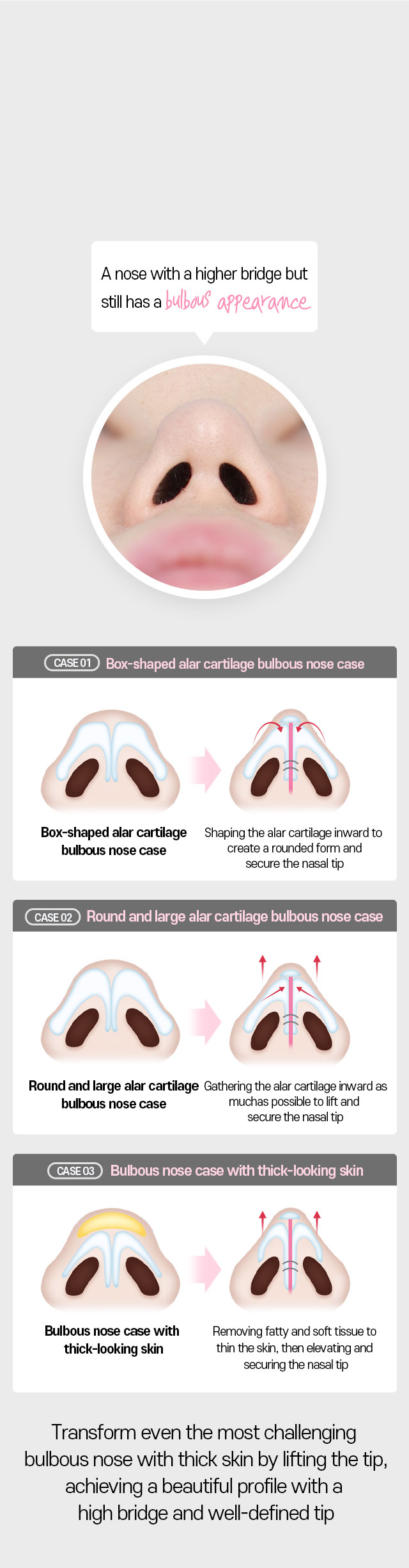 DA Revision Rhinoplasty