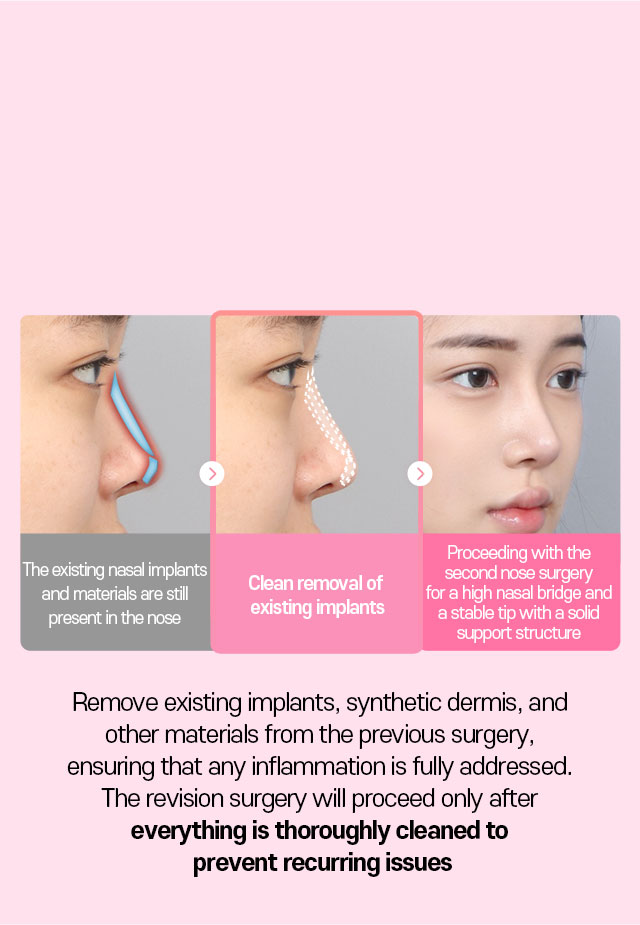 DA Revision Rhinoplasty