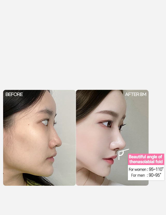 DA Revision Rhinoplasty