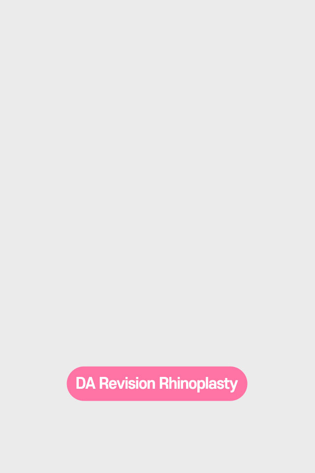 DA Revision Rhinoplasty